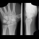 Scaphoid fracture, non-union, osteosynthesis with spongiosa: X-ray - Plain radiograph